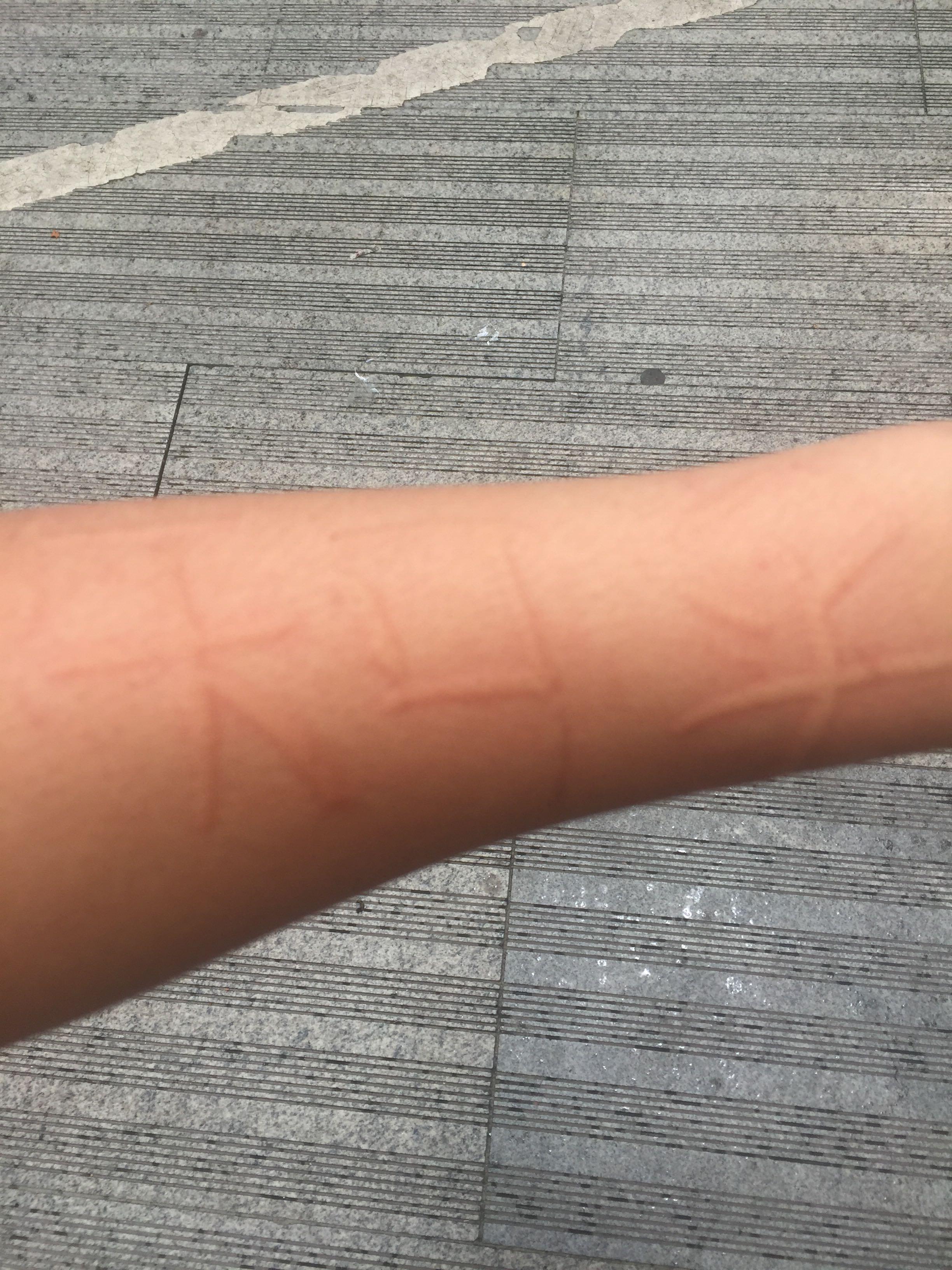 过敏是一种怎样的体验? - 一串代码的回答