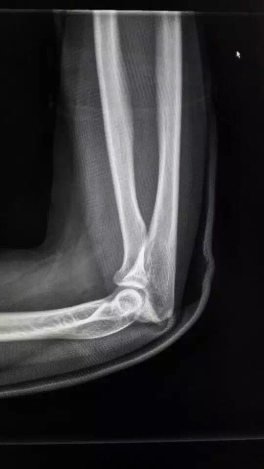 右手肘关节桡骨小头骨裂,两个月多了还疼,是落下后遗症了吗?