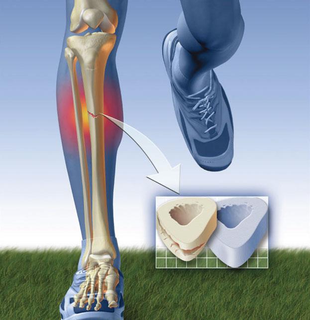 为什么跑步小腿会痛胫骨内侧应力综合征完全康复方案