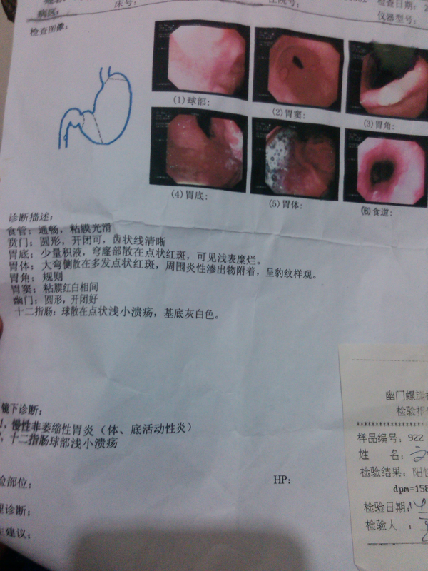 十二指肠球部多发溃疡a1期,慢性浅表性胃炎伴糜烂,hp