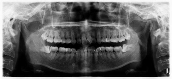人为什么会长智齿?长智齿是好还是坏?为什么