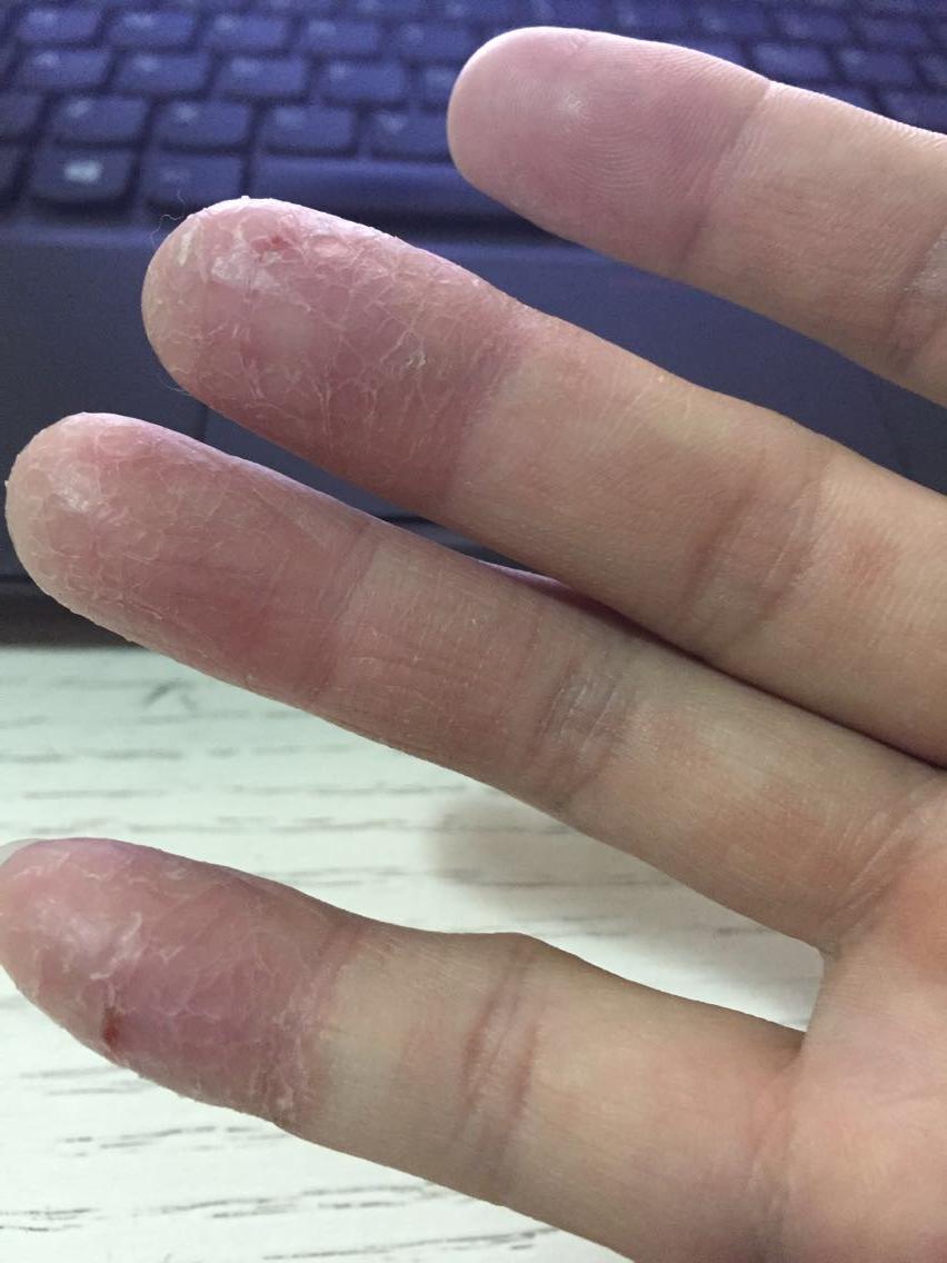 关于湿疹,如何对症下药,又有哪些特效药或好的