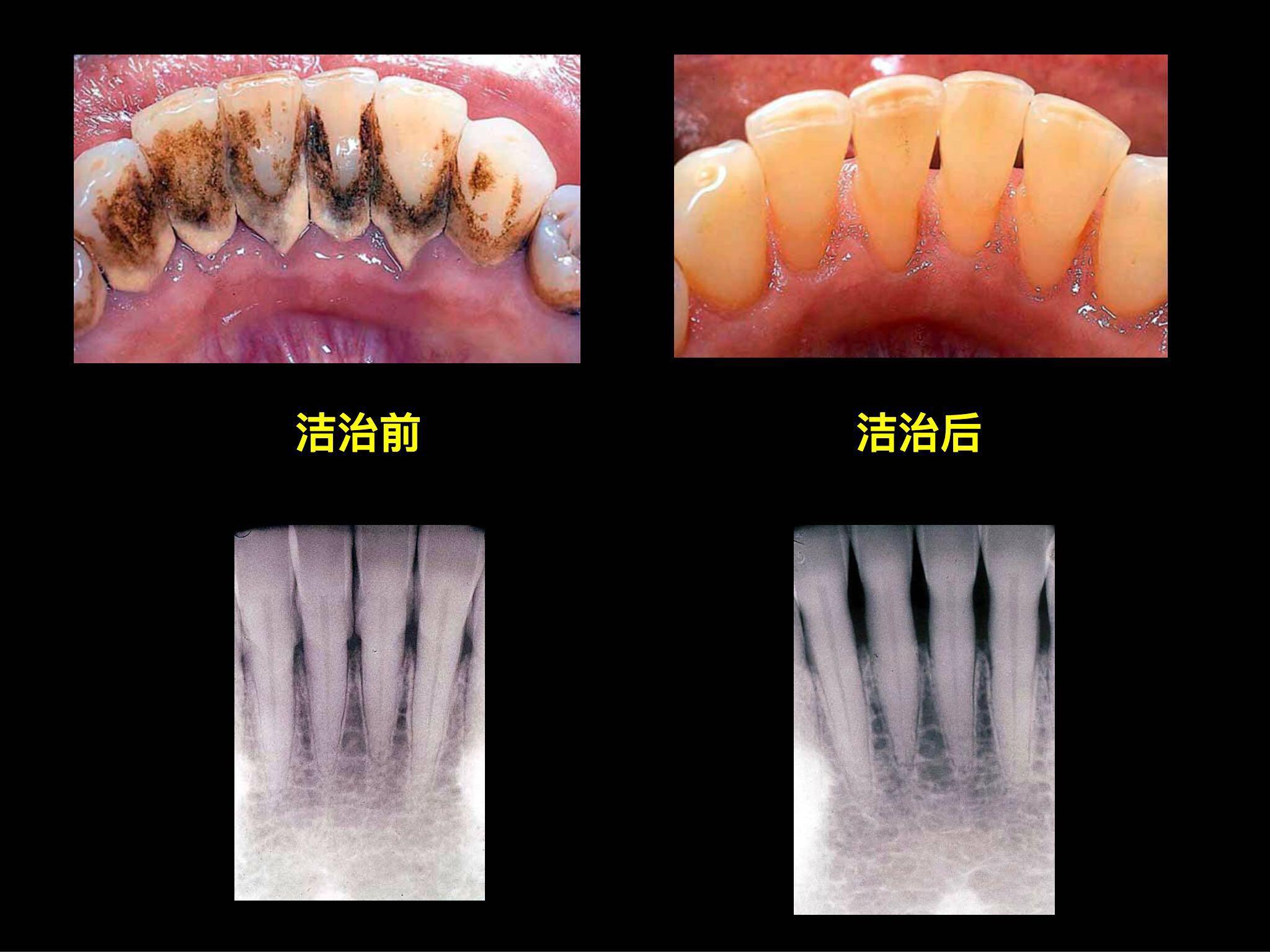 你可以照着镜子嘴巴张大,看下下面门牙舌头那侧是不是有黄黄黑黑的