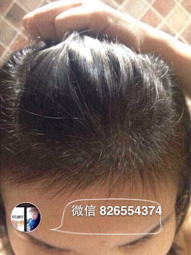 <em>油性头发</em>,大量脱发怎么办? - 张燕子的回答 - 知