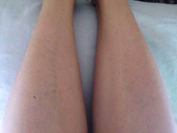 小腿上有鱼鳞状很干燥的皮肤?