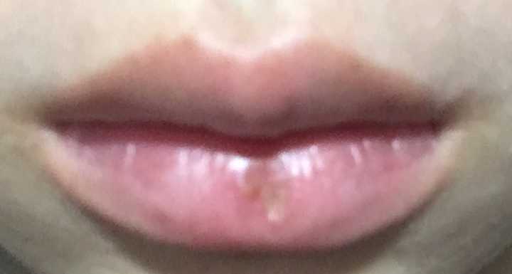为什么上火的时候嘴唇上长水泡都是在上嘴唇,而下嘴唇不长?