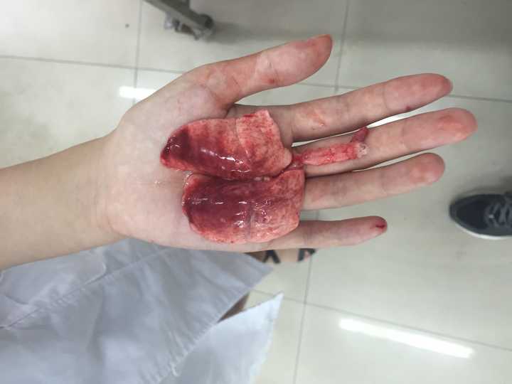 5 人赞同了该回答 肾上腺素中毒剂量静脉注射兔子,马上肺水肿挂掉了