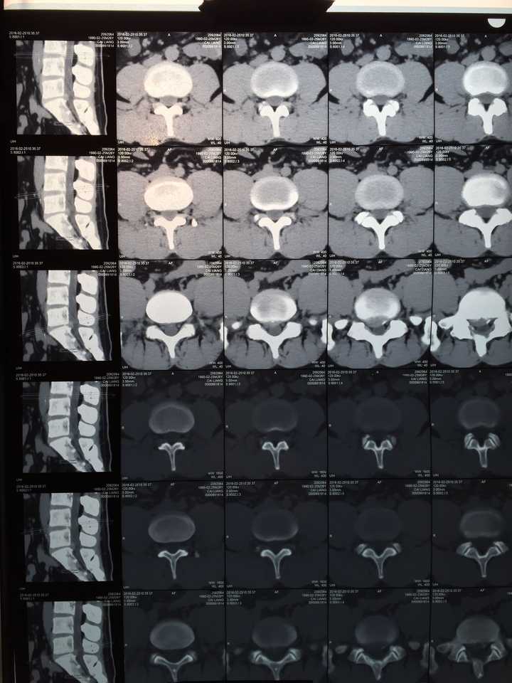 腰椎间盘突出l5s1突出,伴右侧侧窝狭窄?