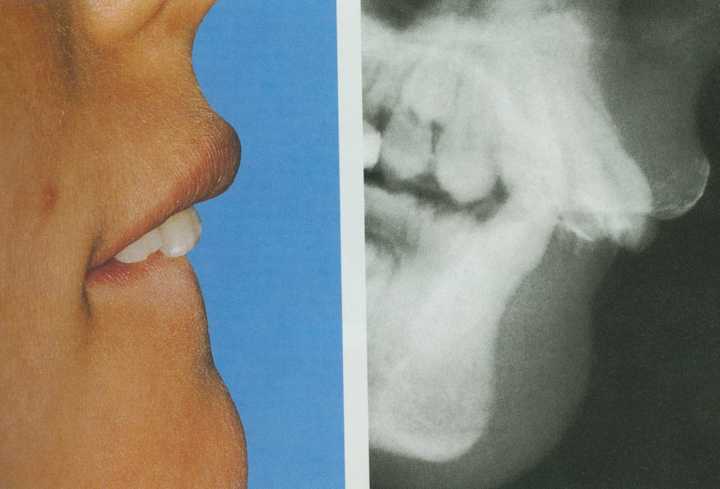 牙齿矫正的适用年龄,好处和问题,能在多大程度上矫正?