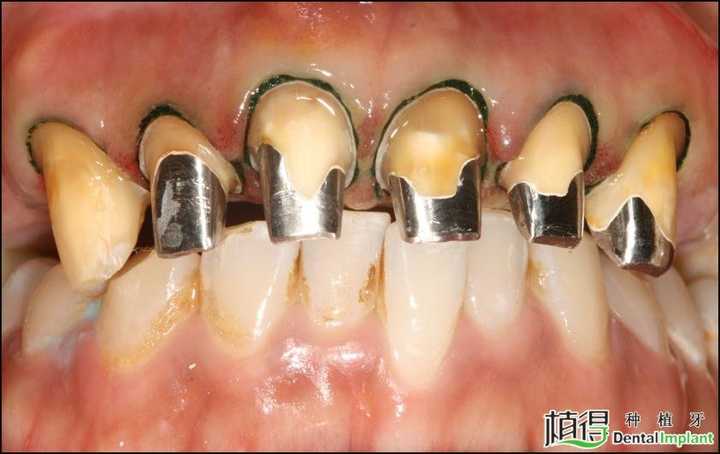 口腔牙体修复中桩冠和桩核冠的区别