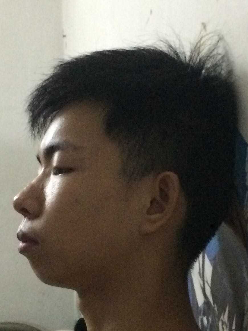 口呼吸 