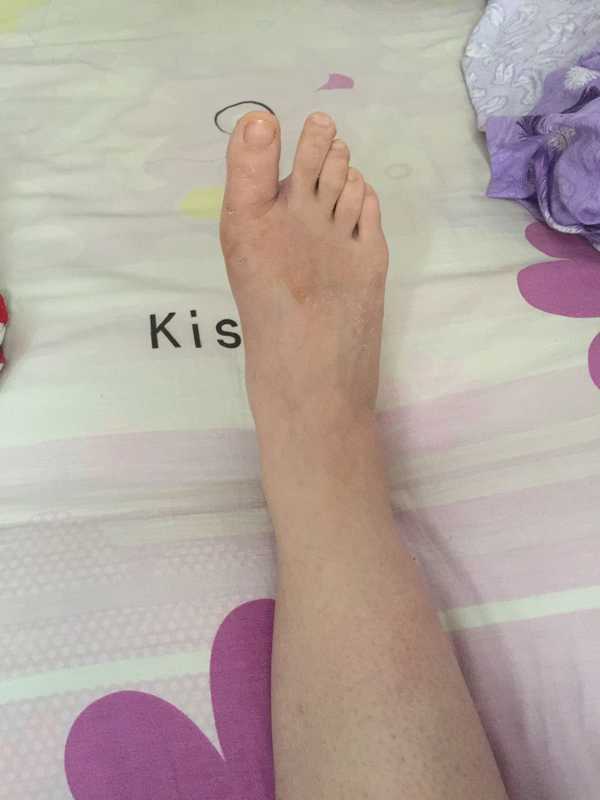 女生脚趾拇外翻是什么样体验?