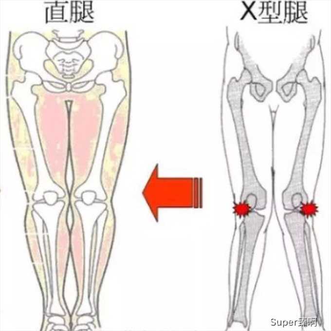 (图片来自网络 )         x型腿恰好相反,施加在腿外侧的力大于内侧