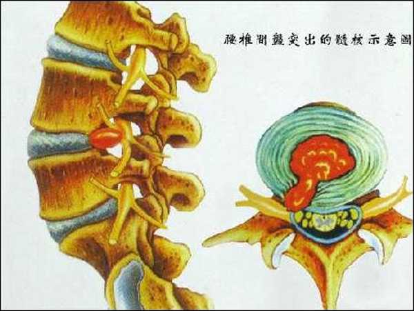 椎间盘突出示意图 腰椎间盘突出症按照突出物的情况分为三种:膨出型