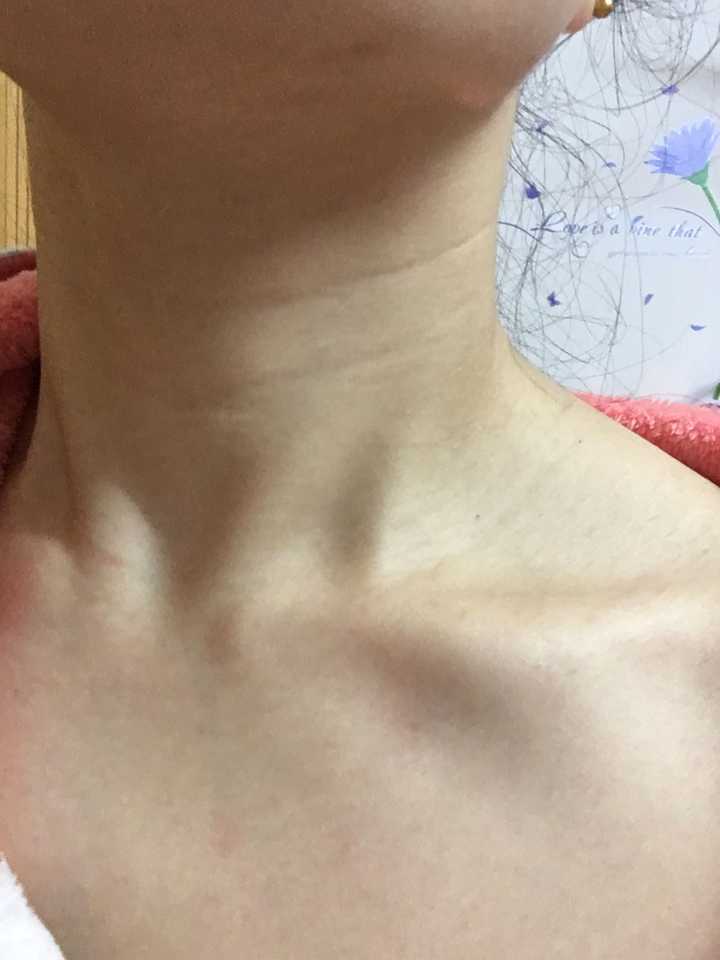也在纠结这个问题,平时也有保养,刚看了好几条答案后又发现锁骨上也有