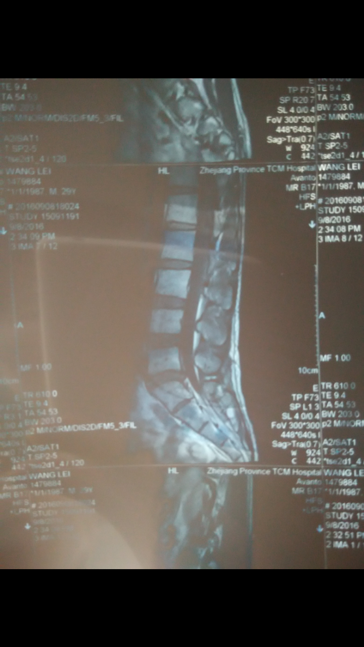 腰椎间盘突出l5s1向后突出?