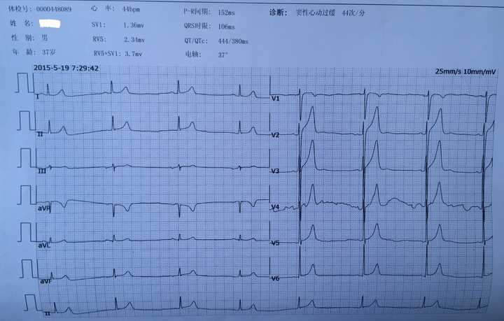 这是我的体检心电图