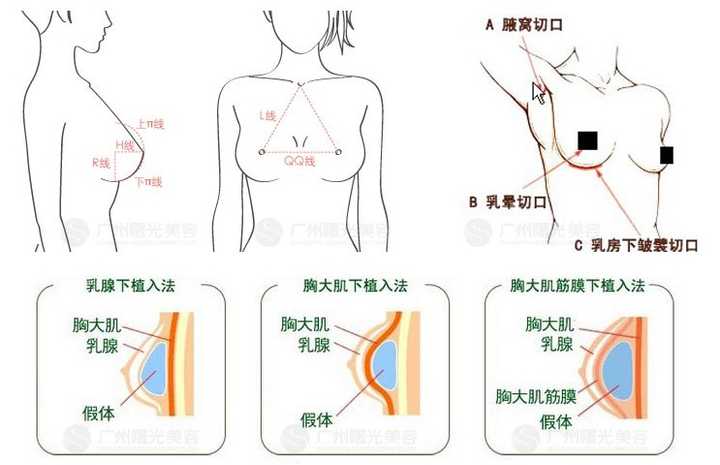 乳腺组织则需以乳头为中心呈放射状切开;或将乳腺组织下缘分出,将乳腺