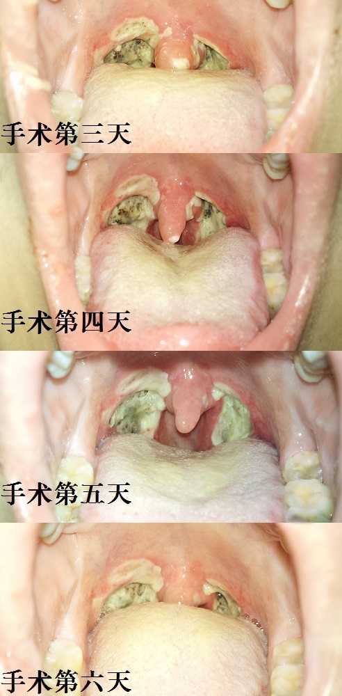 切扁桃体之后是什么感觉?