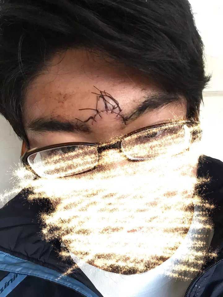 缝针后的样子