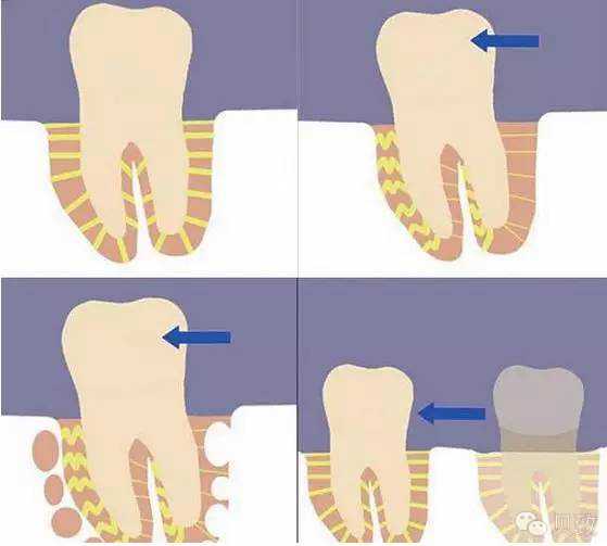 牙槽骨的重建作用,有点类似于"拆东墙补西墙".