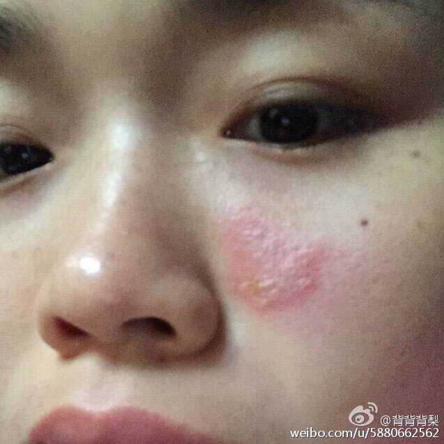 被隐翅虫咬了怎么治?让他自己好?还是要看医生?
