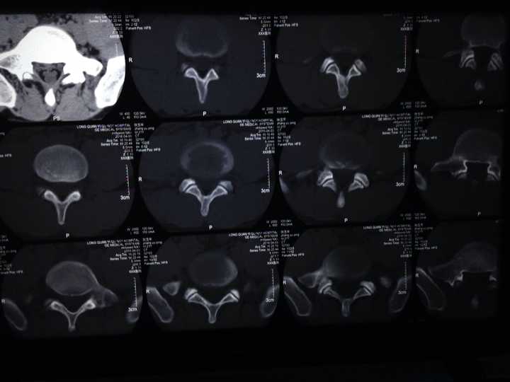 腰椎间盘突出05cm压迫硬膜囊现在已经针灸半个月左腿和屁股好痛啊弯腰