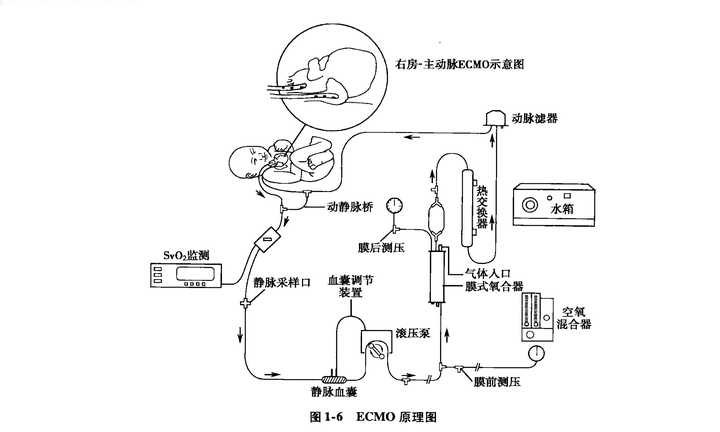 体外膜肺氧合ecmo的原理是什么较之于传统体外循环优势体现在哪些方面