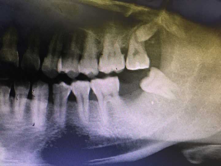 请问牙周炎严重,拔牙后牙槽骨能恢复吗?还是一直是个凹陷?