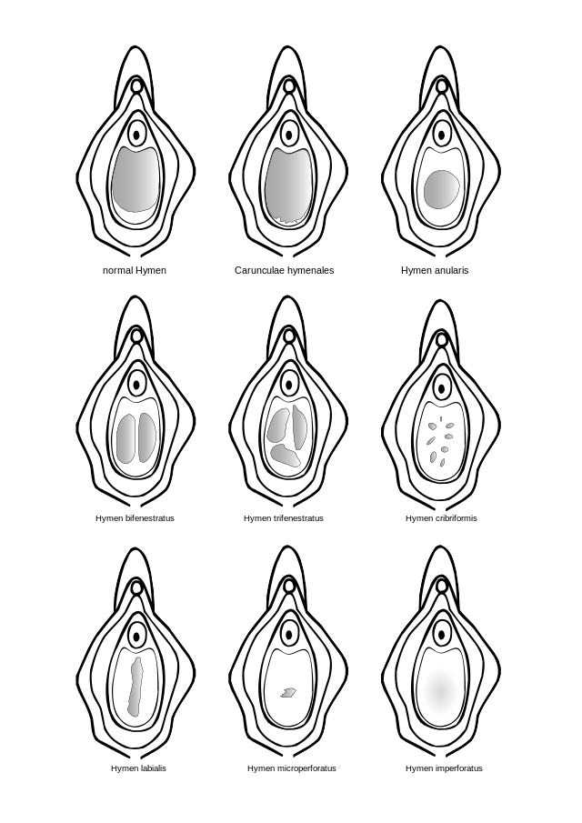 图为不同处女膜形状.