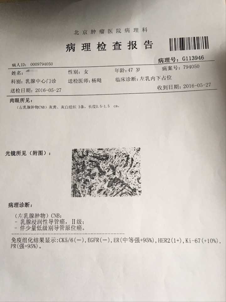 亲人查出乳腺浸润性导管癌,ii级,求大神帮忙分析病情?