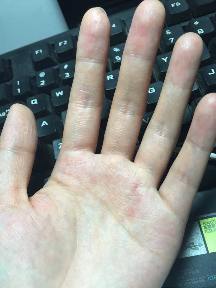 请问手指上长这种小水泡(后期会蜕皮)怎么治啊!求有经验的支个招!