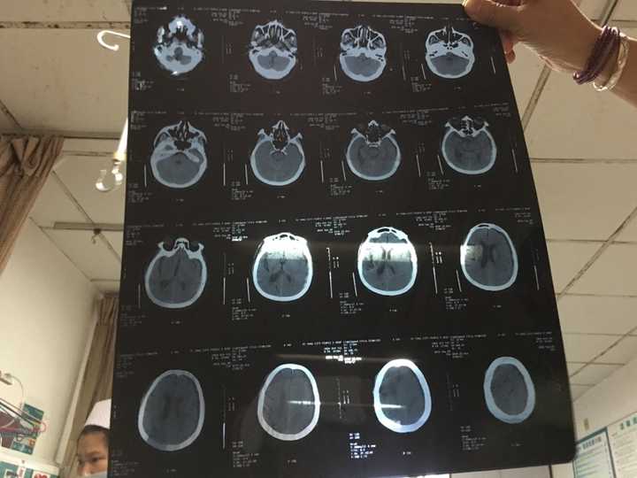 父亲摔倒,脑出血,六天,该怎么更好的治疗?