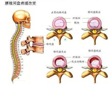 腰间盘突出患者着凉后病情加重的原理是什么?