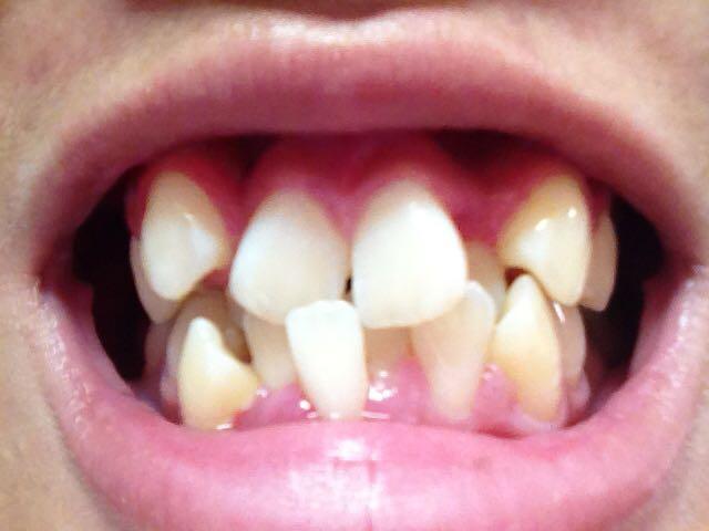 其实还挺对称的 两颗门牙都一样倾斜 门牙旁边的牙齿都缩到后面 然后