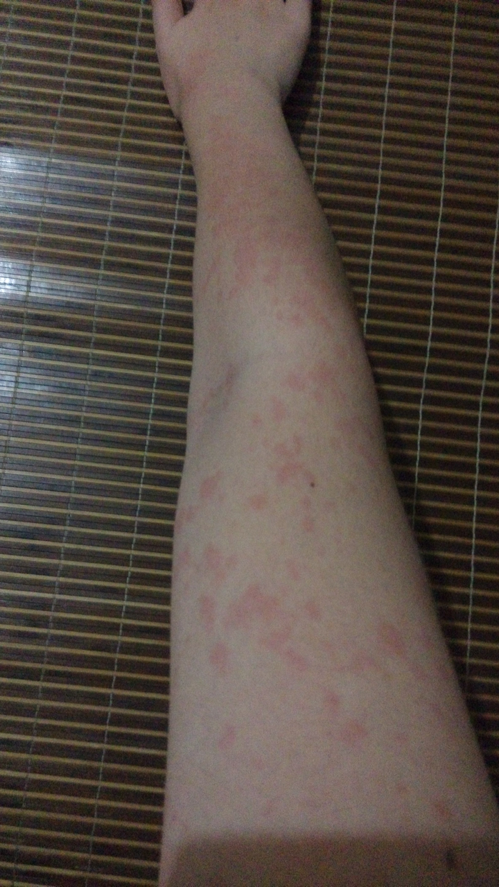 得了荨麻疹是一种怎样的体验?
