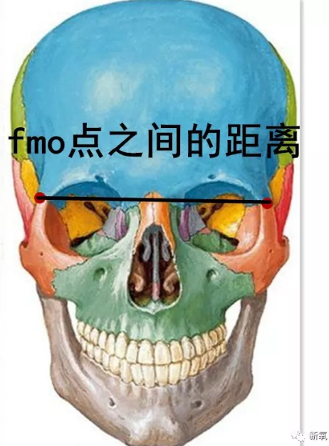 从正面,我们评估立体度是靠两个眶额颧点(fmo)之间的距离,可以理解成