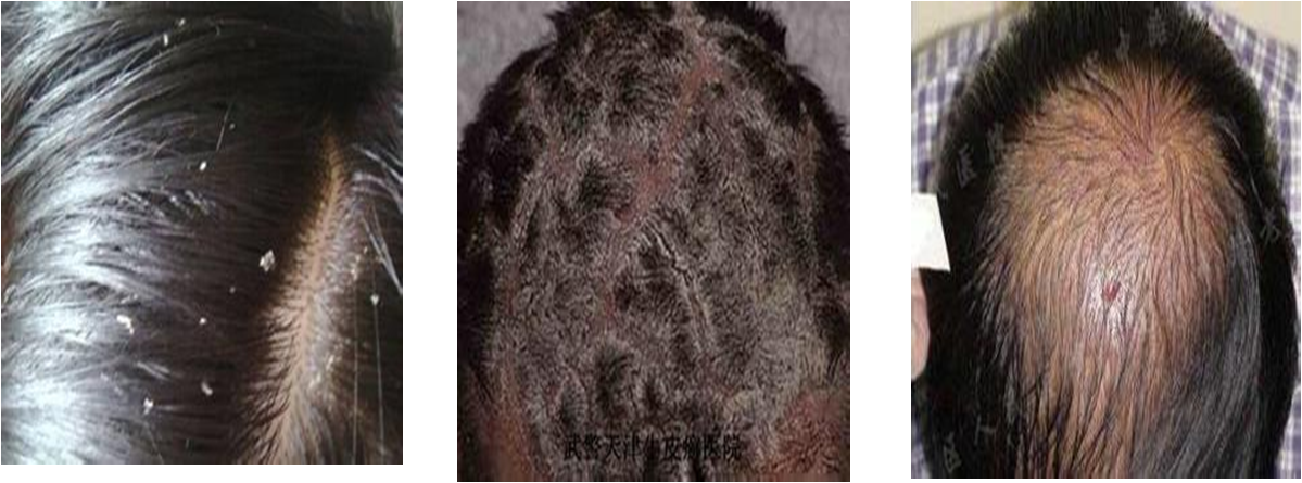 头皮屑在医学上称为头皮糠疹,是一种由马拉色菌(真菌中的一种)引起