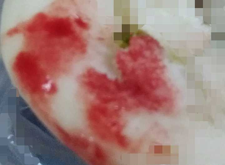 昨天晚上吃东西不小心咬到了舌头 现在还流血 用冷水含一会是止血了