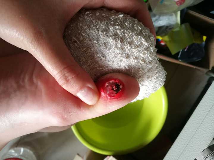 花了好长时间,看了很多案例,激起了治疗鸡眼的兴趣,于是我准备把自己