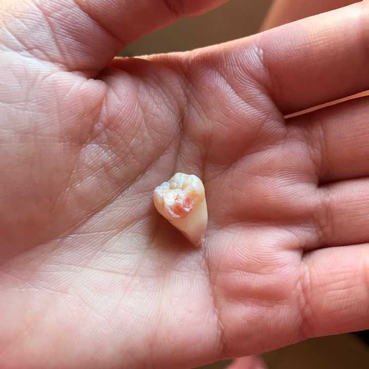 拔智齿有多痛