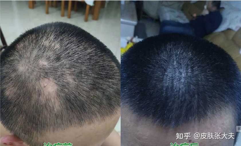 早期斑秃图片大全斑秃什么样斑秃照片斑秃的前期症状