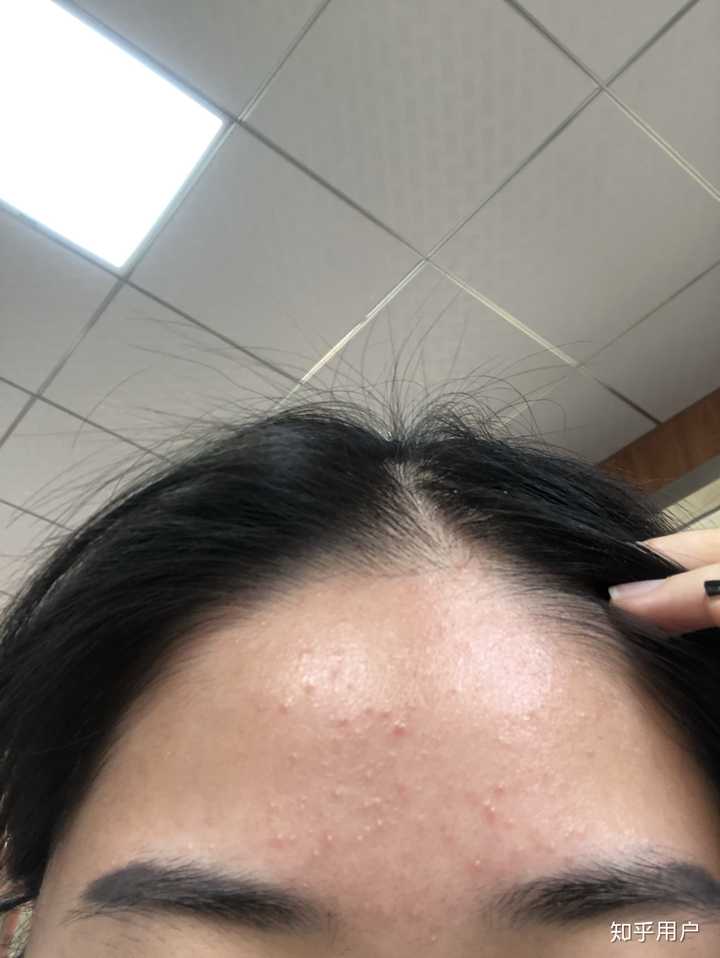 也没有留下痘印 针清之前主要是额头上的闭合型粉刺很多还发红