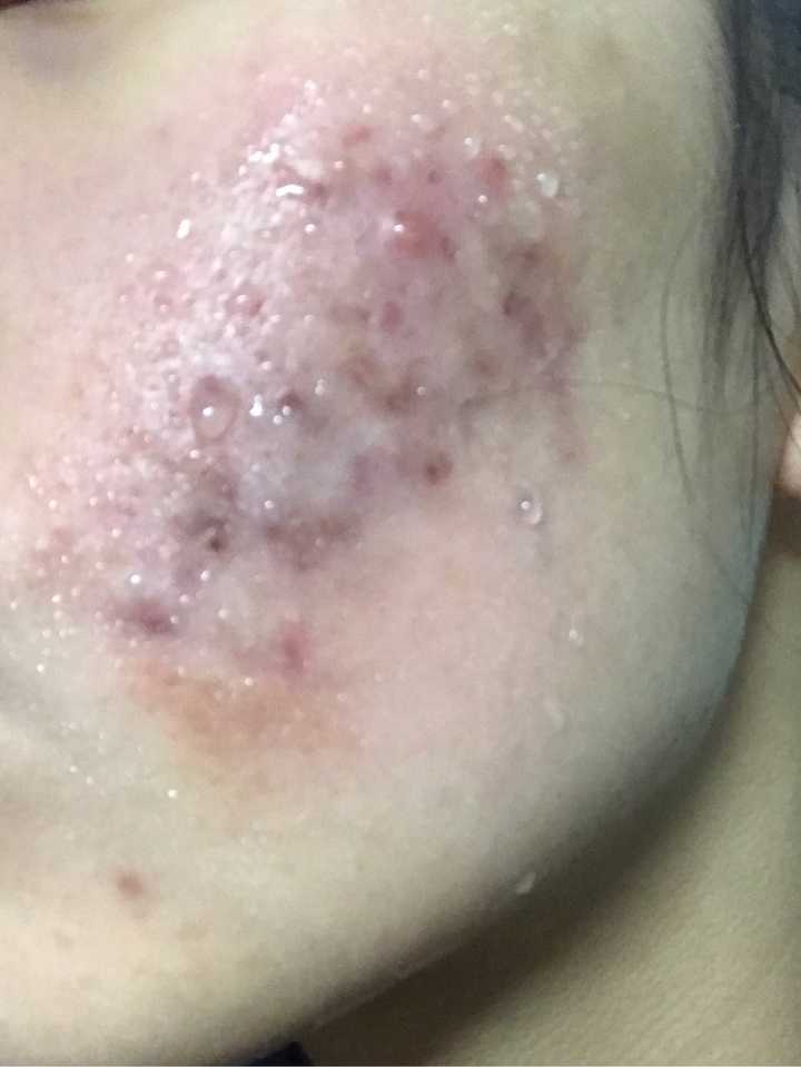 得重度痤疮是种怎样的体验?
