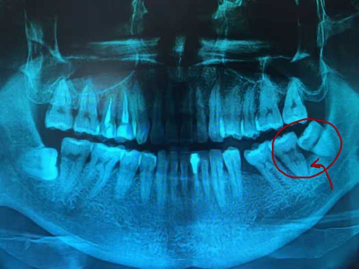 有的朋友反复忍到最后 智齿变成残根残冠,引起慢性根尖周炎,进而引起