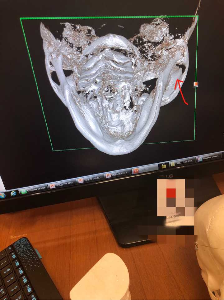 下颌骨磨骨/削骨整形是一种怎样的体验?
