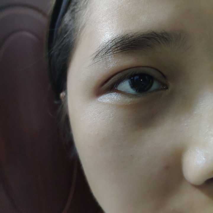 记录自己的埋线双眼皮恢复过程