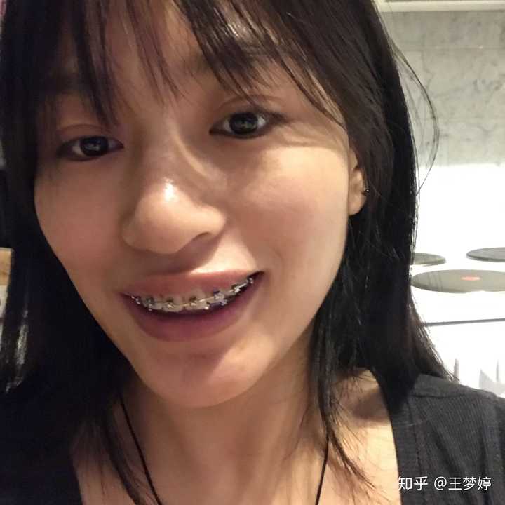 整牙失败是一种什么样的体验?