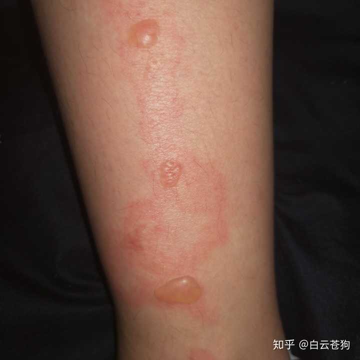 烫伤起的水泡可以戳破吗?