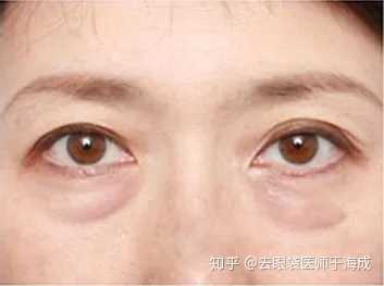 到底眼袋和卧蚕有什么区别啊我这个是眼袋嘛